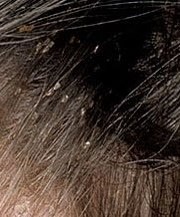 Kill Nits Fairy Licemothers Lice Removal Oceanside